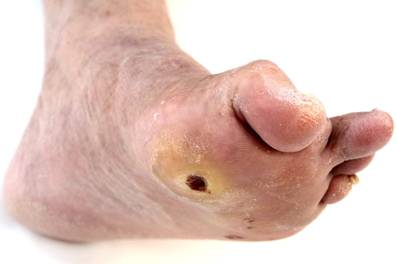Diabetic Foot Ulcer